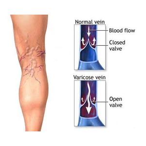 Varicose Veins Treatment Cream