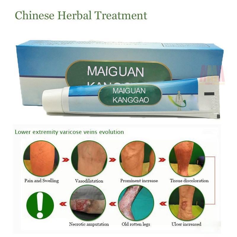 Varicose Veins Treatment Cream