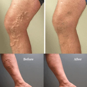 Varicose Veins Treatment Cream